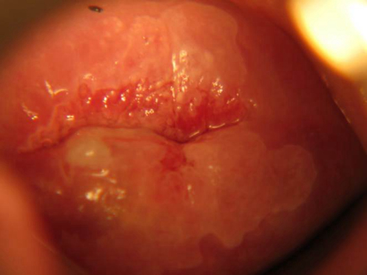 淋病的癥狀及圖片介紹，淋病的癥狀詳解與圖片介紹