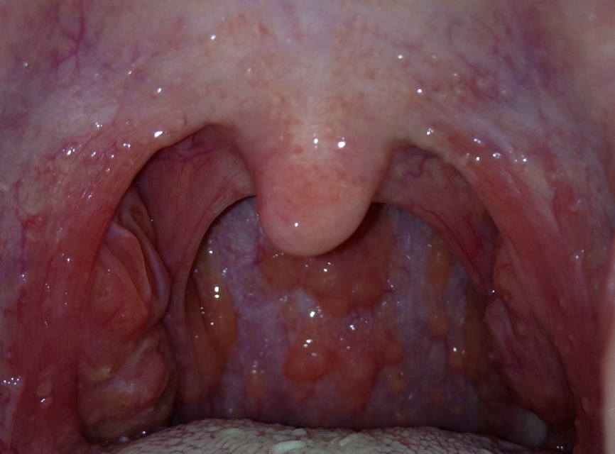 咽喉感覺有異物感但吞咽正常，原因、影響與處理方法，咽喉異物感解析，成因、影響及應(yīng)對之策