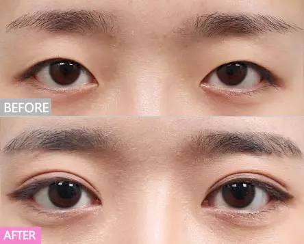 上海割雙眼皮最好的專家，專業(yè)團(tuán)隊與個性化設(shè)計的完美結(jié)合，上海雙眼皮手術(shù)專家團(tuán)隊，專業(yè)與個性化設(shè)計的完美融合