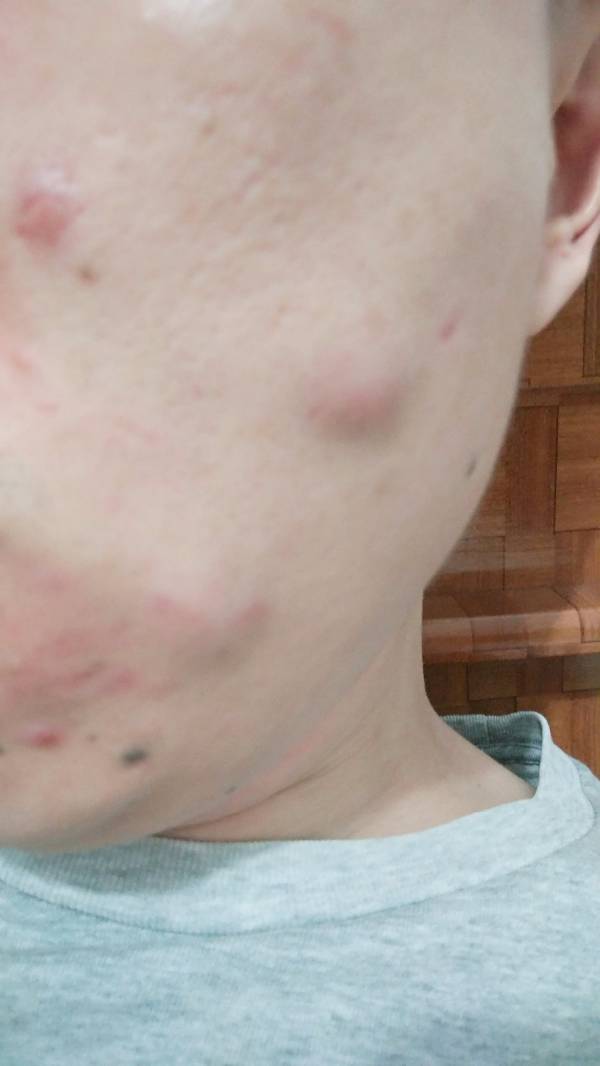 癤腫的硬包消除方法，全面解析與實用建議，癤腫硬包消除全攻略，實用方法與解析