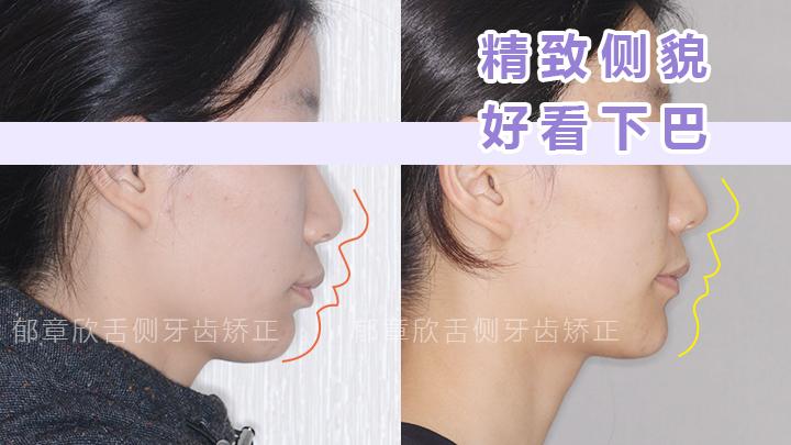 下巴后縮矯正方法詳解，下巴后縮矯正方法全面解析
