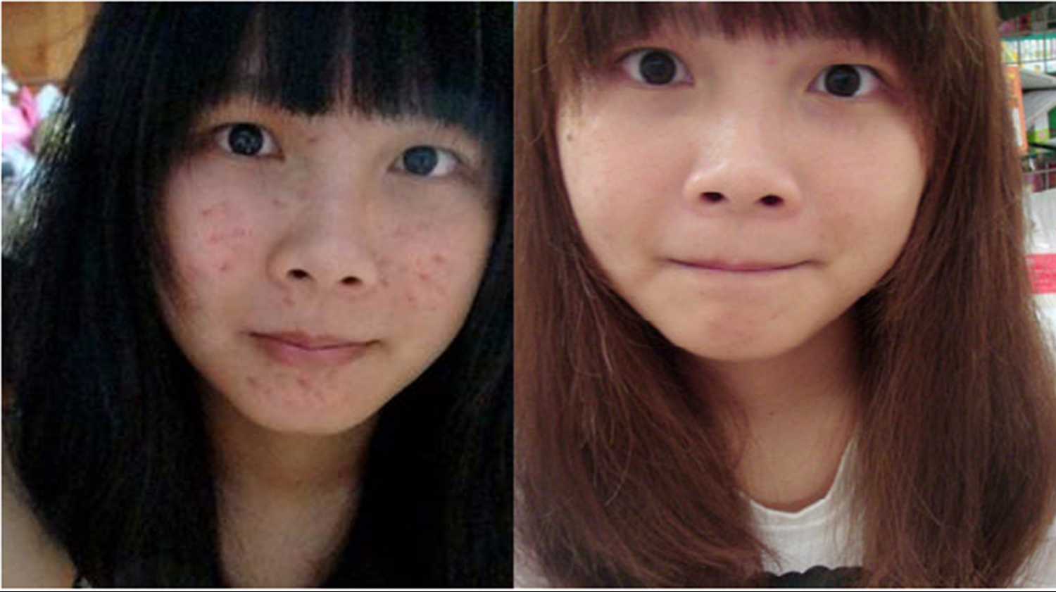 如何去除痘印，全面解析痘印消除方法，全面解析，痘印消除攻略，重塑肌膚無暇美！