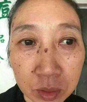 去老年斑的簡單方法，重拾肌膚光彩的秘訣，去老年斑秘籍，重拾肌膚光彩的簡易方法