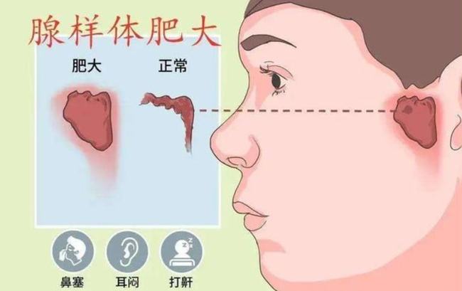 腺樣體肥大能自愈嗎？——深度解析與理解，腺樣體肥大能否自愈？全面深度解析
