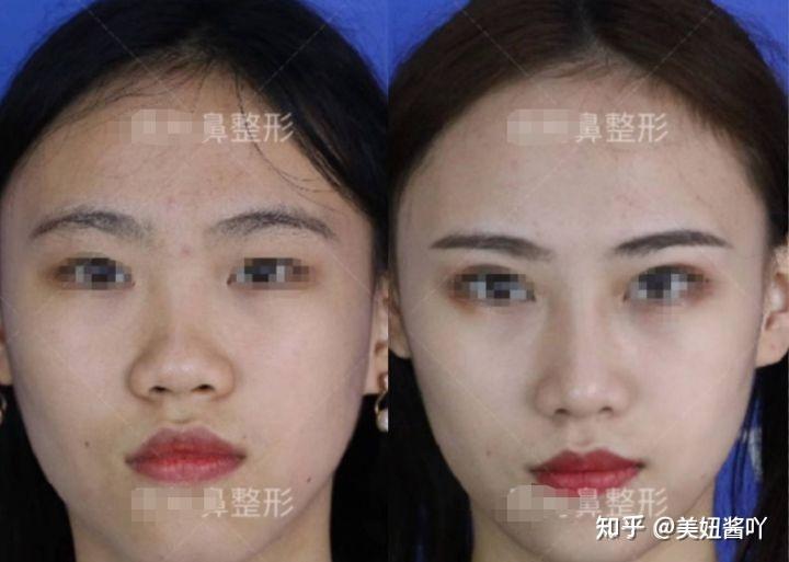 成都隆鼻專家前十名，專業(yè)技藝與信譽(yù)并重，成都隆鼻專家前十名，技藝與信譽(yù)并重的專業(yè)醫(yī)師