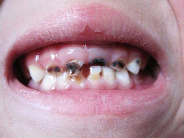 初期蛀牙的樣子圖片，了解并預(yù)防牙齒的隱形威脅，初期蛀牙圖片展示，認識并預(yù)防牙齒隱形威脅