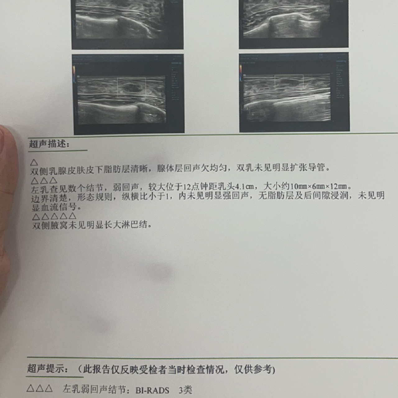 乳腺結(jié)節(jié)3類嚴重嗎？解讀乳腺健康，讓你了解真相，乳腺結(jié)節(jié)3類嚴重嗎？解讀乳腺健康真相