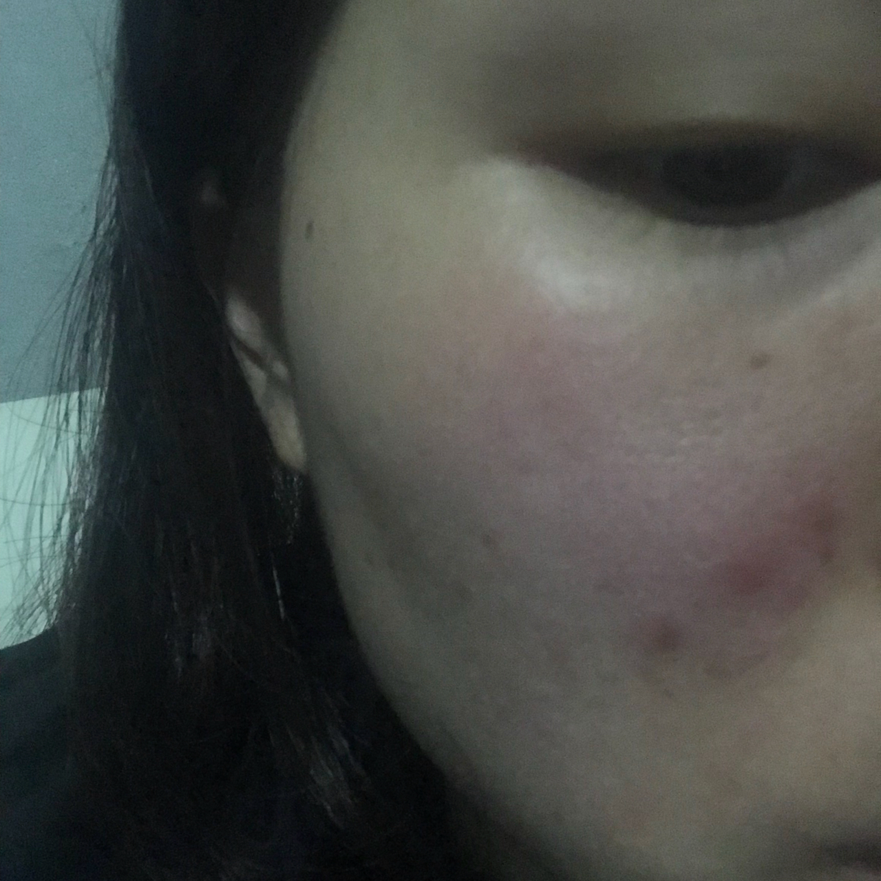 臉上擠不出來卻摸著硬包，成因解析與應(yīng)對(duì)建議，臉上硬包成因解析，如何應(yīng)對(duì)擠不出來的困擾