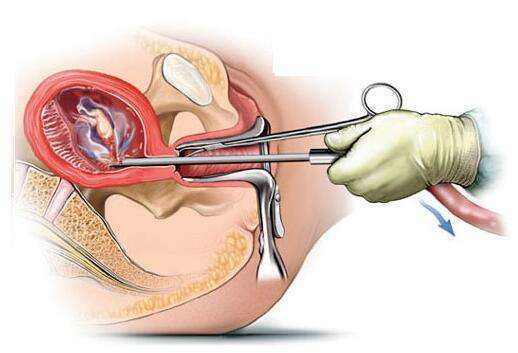 無痛人流術(shù)后醒來的疼痛感受解析，無痛人流術(shù)后醒來的疼痛感受解析及應對建議