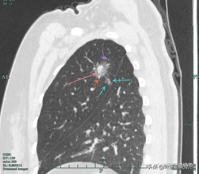 肺部結節(jié)通過食用三七成功消失，奇跡般的自然療法，奇跡般的自然療法，食用三七成功消除肺部結節(jié)