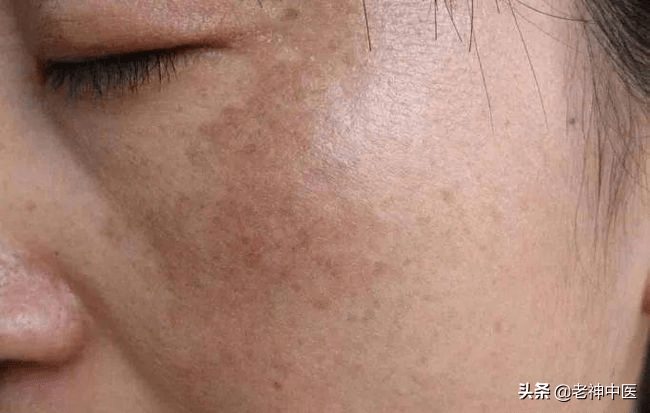 黃褐斑最怕一味中藥，深入解析與應(yīng)對策略，黃褐斑的克星，中藥深度解析與防治策略