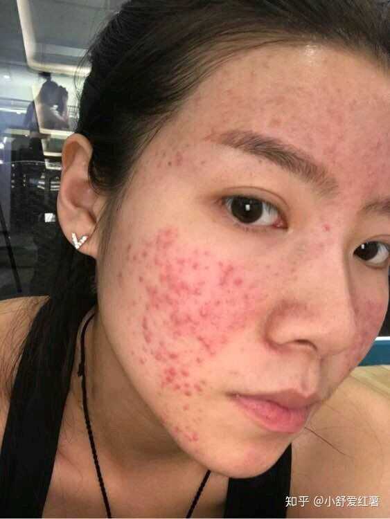 如何有效去除臉上的痘印——全方位指南，全方位指南，如何有效去除臉上痘印的方法