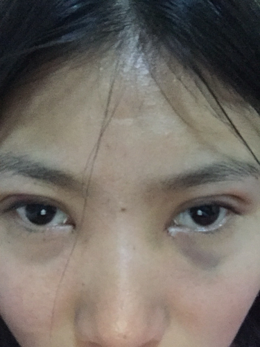 關(guān)于開眼角與割雙眼皮手術(shù)費用解析，究竟需要多少錢？，開眼角與割雙眼皮手術(shù)費用全解析，究竟要花多少錢？