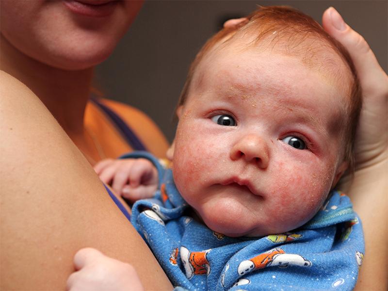 兒童常見(jiàn)的幾種疹子及其識(shí)別與處理方法，兒童常見(jiàn)疹子類(lèi)型、識(shí)別與處理方法指南