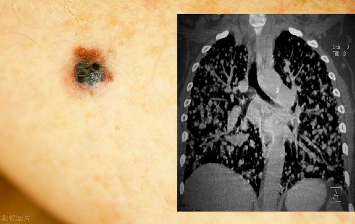 惡性黑色素痣初期的識別與應對，惡性黑色素痣初期識別與防治攻略