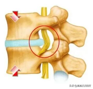 腰椎間盤突出怎么治療斷根，全面解析最佳方案，腰椎間盤突出最佳治療斷根方案解析