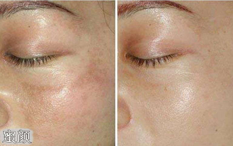 用激光祛斑效果怎么樣？全面解析激光祛斑的優(yōu)缺點(diǎn)，激光祛斑效果全面解析，優(yōu)缺點(diǎn)一覽無遺