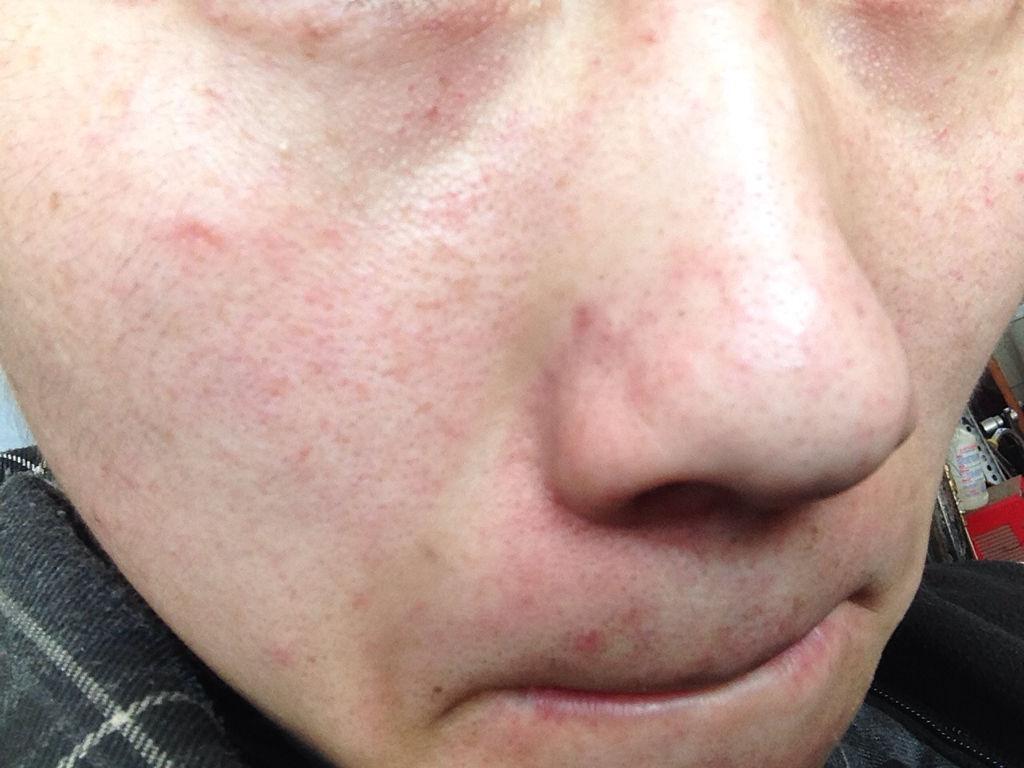 去掉臉上紅血絲的小妙招，消除臉部紅血絲的實(shí)用小妙招