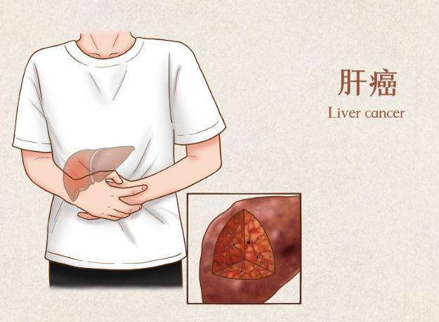 肝癌一般三處痛，癥狀解析與應對策略，肝癌癥狀解析，疼痛位置、應對策略及三處痛詳解