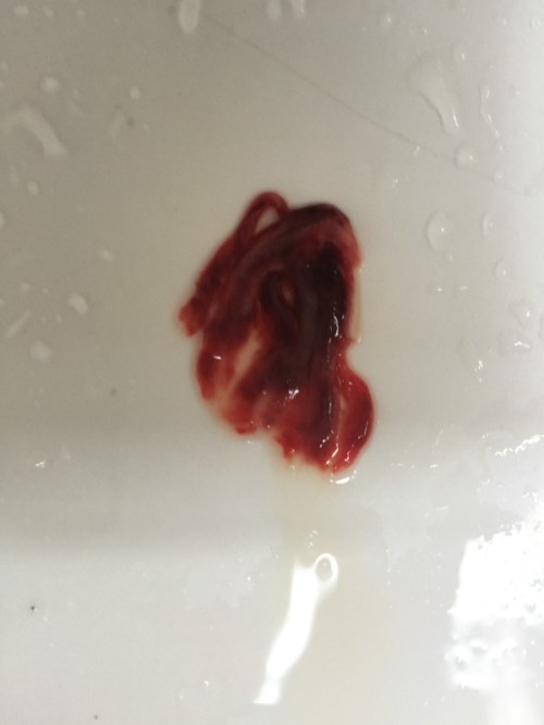 經(jīng)期排出淤血的技巧，優(yōu)化你的生理健康與生活質(zhì)量，經(jīng)期淤血排除技巧，提升生理健康與生活質(zhì)量之道