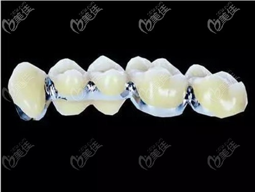 鈷鉻烤瓷牙價格解析，多少錢一顆？，鈷鉻烤瓷牙價格詳解，每顆費用是多少？