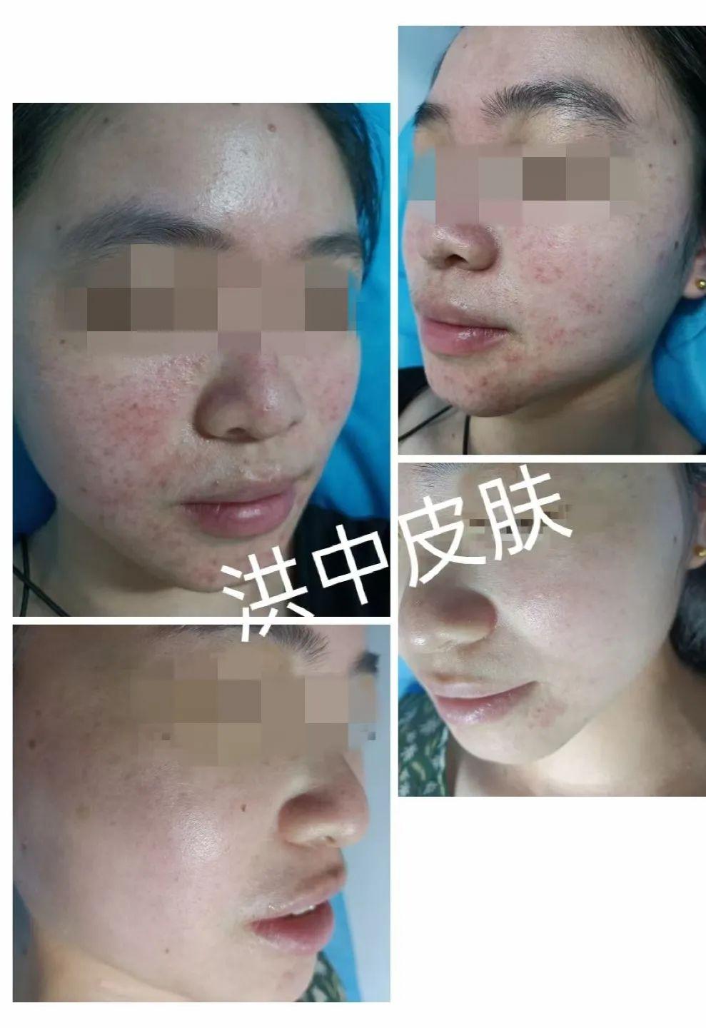 痤瘡圖片的樣子，深入了解痤瘡癥狀與表現(xiàn)，痤瘡癥狀深度解析，圖片展示痤瘡表現(xiàn)與形態(tài)