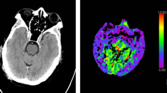 腦CT沒(méi)事就代表大腦沒(méi)事嗎？深入探討腦部健康與CT檢查的關(guān)系，腦部健康與CT檢查，CT無(wú)異常是否代表大腦無(wú)隱患？
