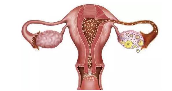 小姑娘為什么會(huì)得卵巢囊腫，小姑娘患卵巢囊腫的原因分析