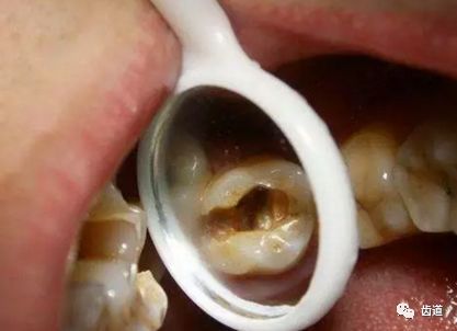如何判斷牙齒牙洞已經(jīng)深入到牙髓？，牙齒牙洞深度判斷，如何確定已影響牙髓？