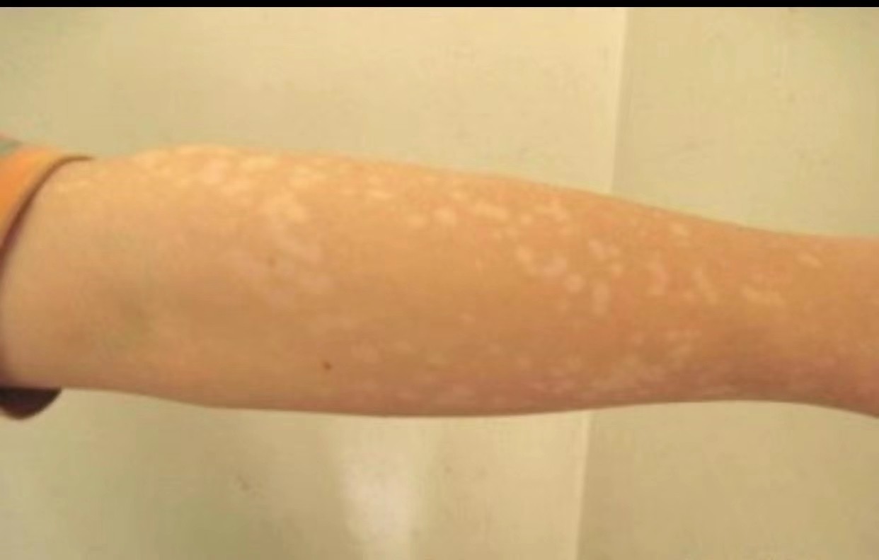 白斑與汗斑的區(qū)別圖，深入了解兩種皮膚狀況的差異，白斑與汗斑的區(qū)別詳解，圖解兩者皮膚狀況差異