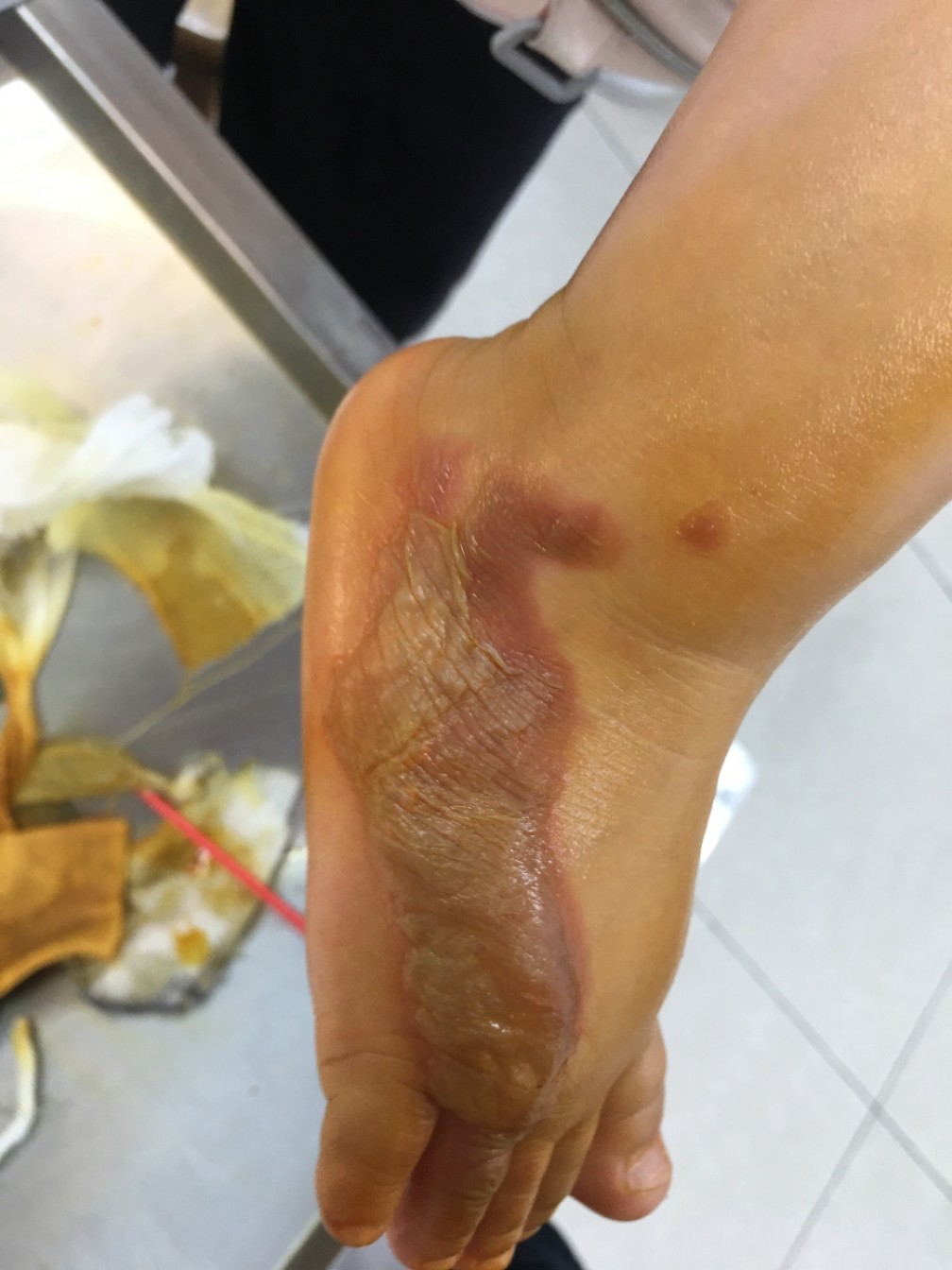 燙傷后如何選用最佳藥膏，避免留下疤痕，燙傷藥膏選擇與疤痕預防，燙傷后的最佳護理指南