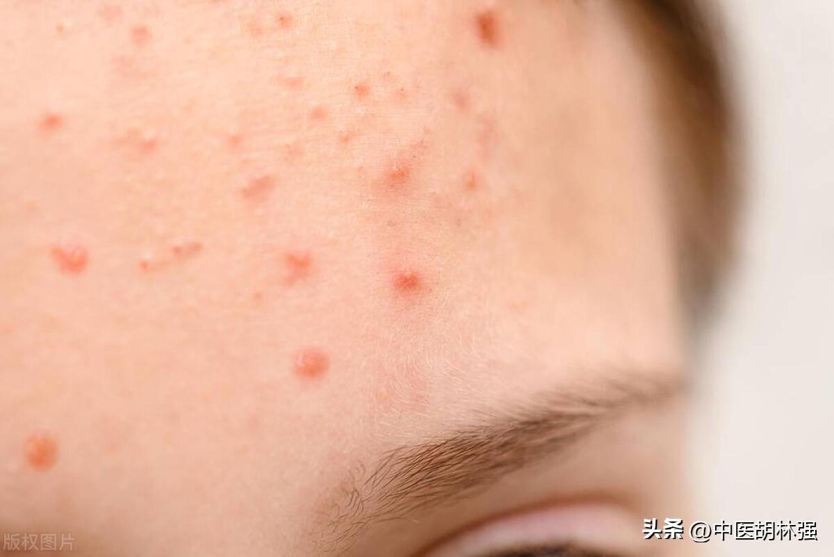 喉嚨發(fā)炎如何快速消炎——全方位指南，喉嚨發(fā)炎全方位快速消炎指南