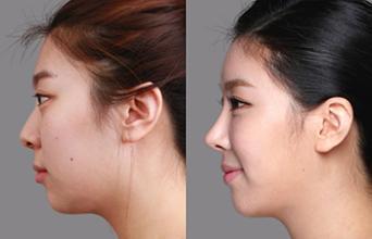 耳軟骨隆鼻的危害有哪些，深入了解與防范，耳軟骨隆鼻的危害解析，深入了解及防范措施