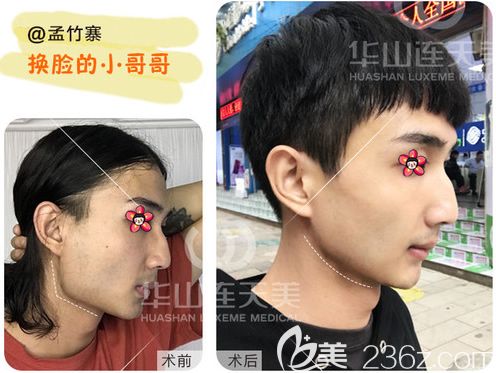 削顴骨手術(shù)費(fèi)用詳解，手術(shù)費(fèi)用大概要多少錢？，削顴骨手術(shù)費(fèi)用詳解，手術(shù)費(fèi)用及預(yù)算指南