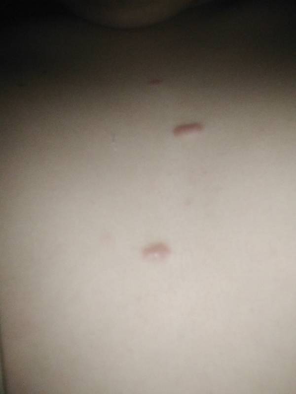 下面長(zhǎng)了一個(gè)硬疙瘩一碰就疼，原因、診斷與治療方法，私密部位硬疙瘩，成因、診斷與治療方法