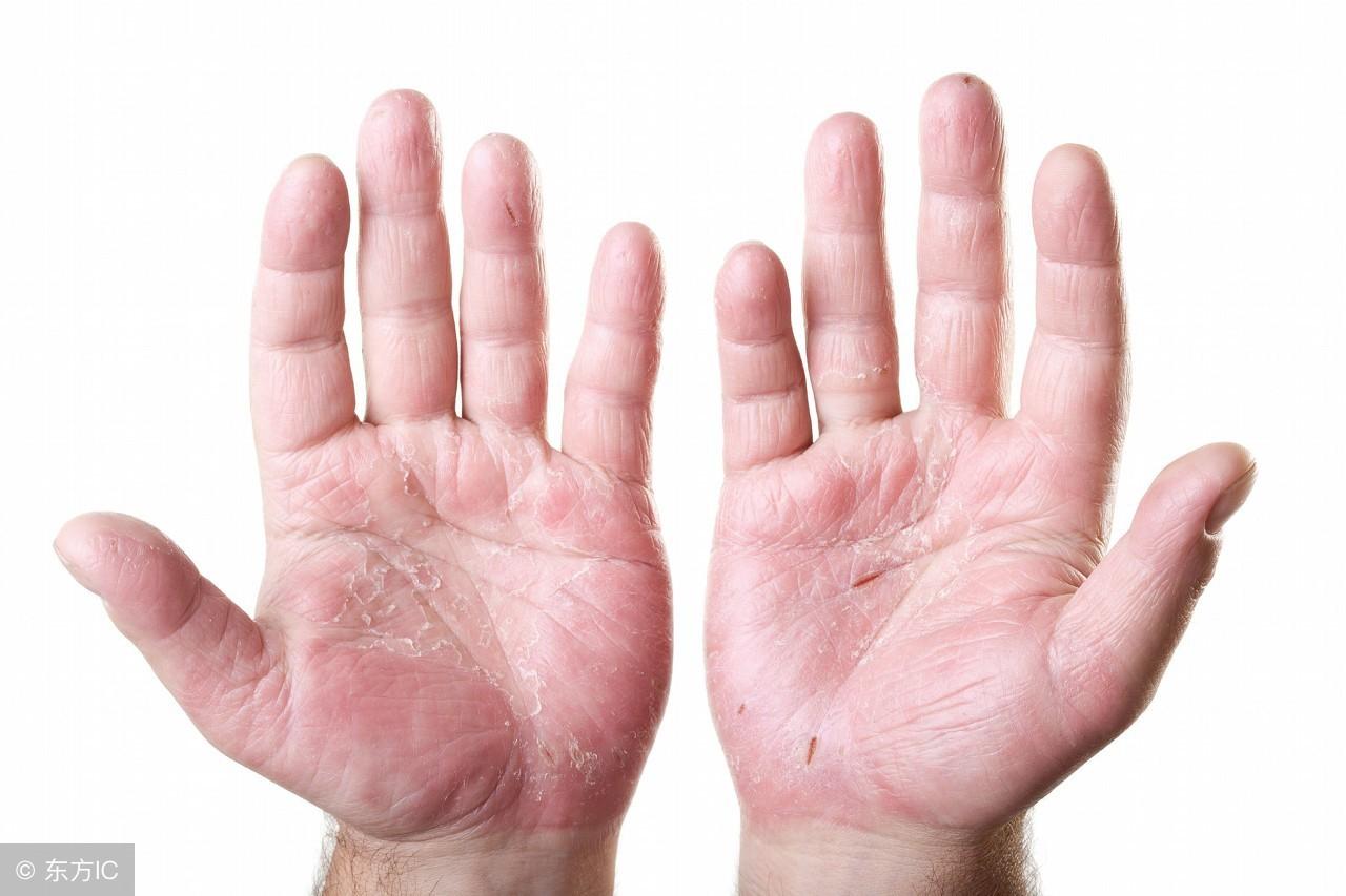 濕疹怎么治療，全面解析有效的治療方法，全面解析濕疹的有效治療方法