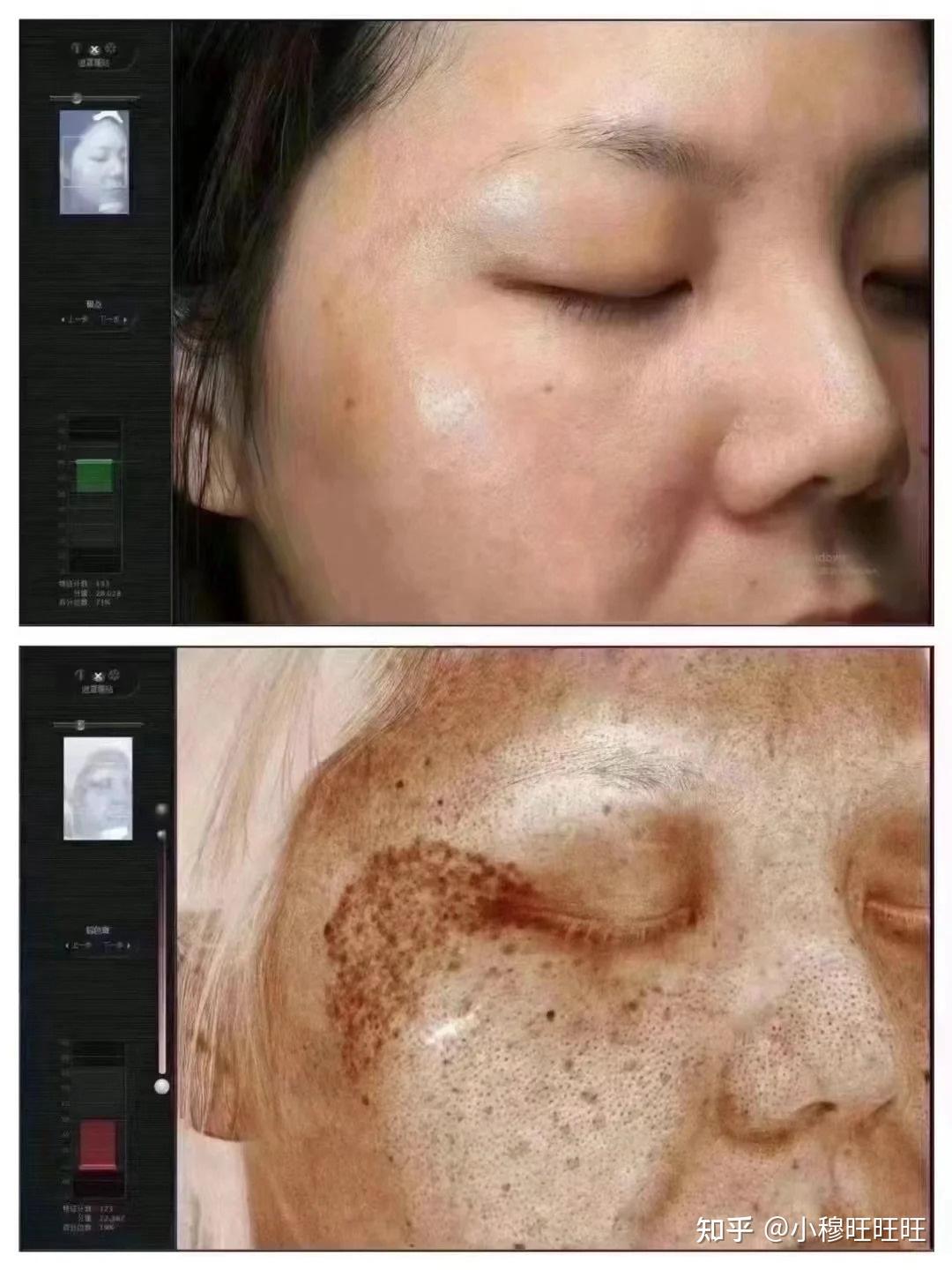 激光祛斑，選擇醫(yī)院還是美容院？全面解讀助您做出明智決策，激光祛斑，如何選擇醫(yī)院與美容院？全面解讀為您指明決策方向