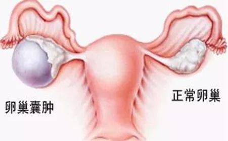 卵巢囊腫的十個征兆，卵巢囊腫的十個征兆解析