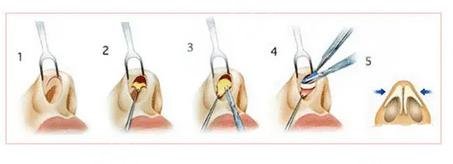 微調(diào)鼻子需要多少錢，全面解析費用因素與注意事項，微調(diào)鼻子費用全解析，費用因素與注意事項，需要多少錢？