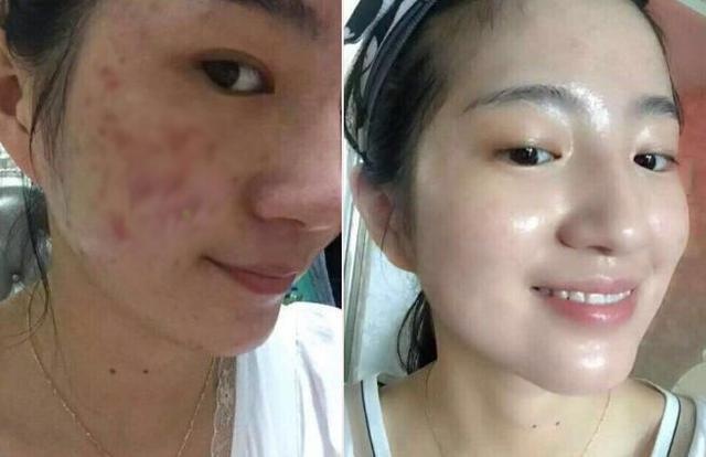 痘印多久會(huì)自己消失？全面解析痘印消失時(shí)間與影響因素，痘印消失時(shí)間全面解析，影響因素與消失時(shí)長(zhǎng)探討