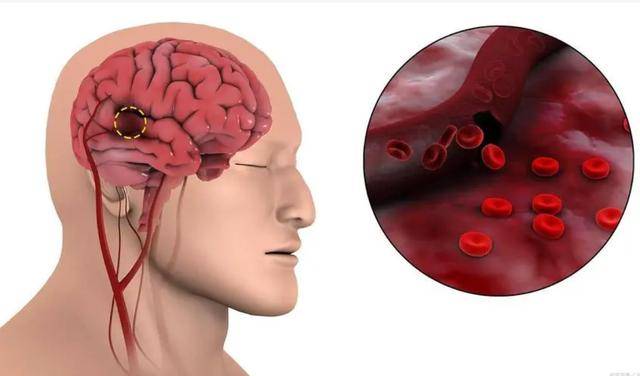 如何判斷自己是否腦供血不足——癥狀解析與應(yīng)對(duì)策略，腦供血不足的判斷方法，癥狀解析及應(yīng)對(duì)之策