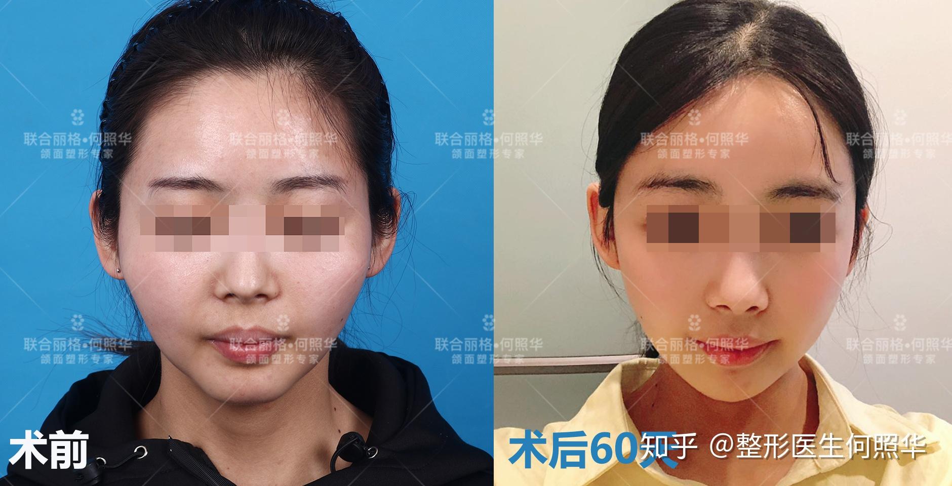 顴骨內(nèi)推3D演示，深入理解手術(shù)過程與效果，顴骨內(nèi)推手術(shù)過程與效果的3D演示理解