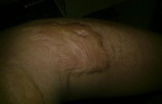 當(dāng)兵不合格的疤痕圖，解析與應(yīng)對建議，當(dāng)兵不合格疤痕圖詳解及應(yīng)對建議