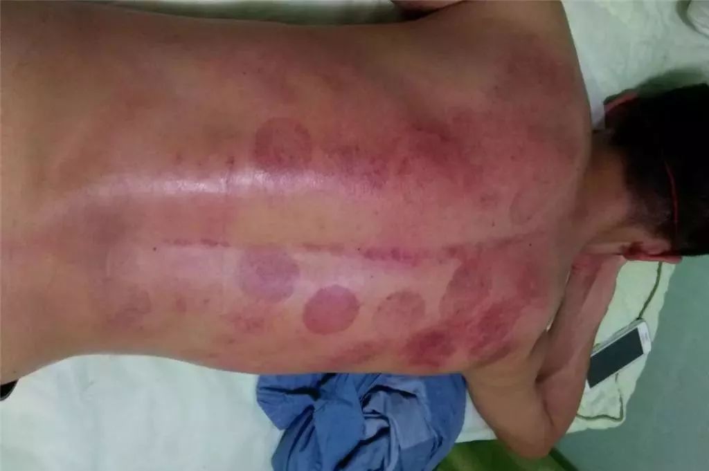 艾灸后如何判斷濕氣排出——一種直觀而實(shí)用的方法，艾灸后判斷濕氣排出的實(shí)用方法指南