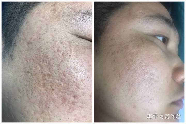 如何有效去除臉上的痘坑痘??？全面解析你的肌膚問(wèn)題，全面解析，如何有效去除臉部痘坑痘印，重塑肌膚光彩