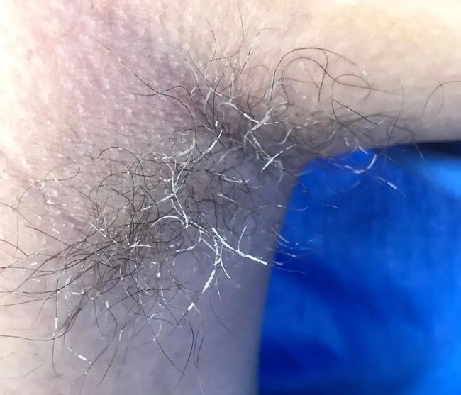 假性狐臭和狐臭的區(qū)別，假性狐臭與狐臭的差異解析