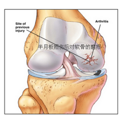 半月板最佳恢復方法，全方位指導與策略，全方位指導策略，半月板損傷的最佳恢復方法