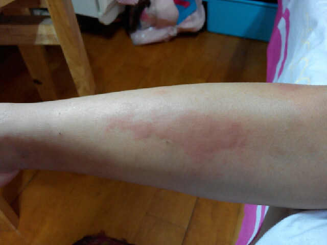 我用偏方成功治愈蕁麻疹，經(jīng)歷與分享，我用偏方成功治愈蕁麻疹，經(jīng)歷分享與治愈之路