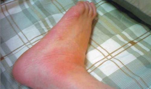 痛風(fēng)發(fā)作如何快速止痛消腫——痛風(fēng)患者的自救指南，痛風(fēng)發(fā)作快速止痛消腫自救指南