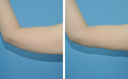 手臂抽脂價格一覽表——打造纖細玉臂的必備指南，手臂抽脂價格詳解，打造纖細玉臂的必備指南